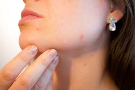 Effective ways to get rid of Pimple Scars